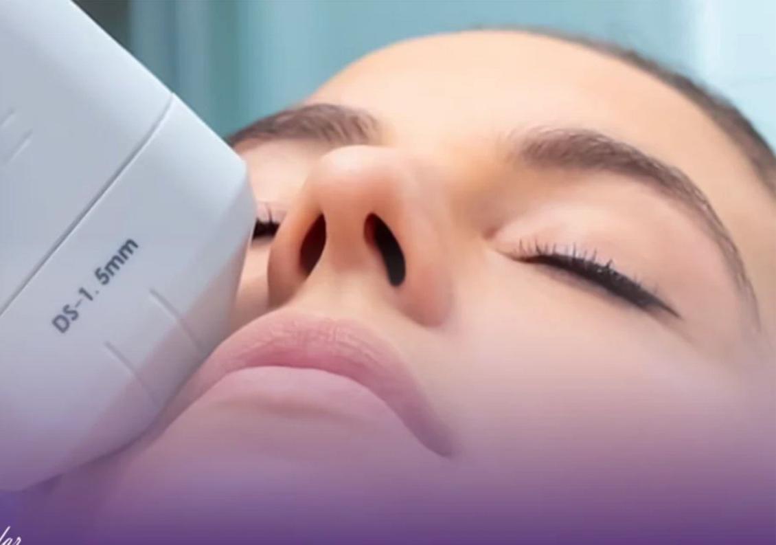 ​HIFU 7D Pro Blaricum